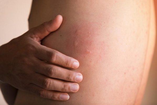 5 Cara Efektif Mengatasi Kulit Gatal dan Iritasi