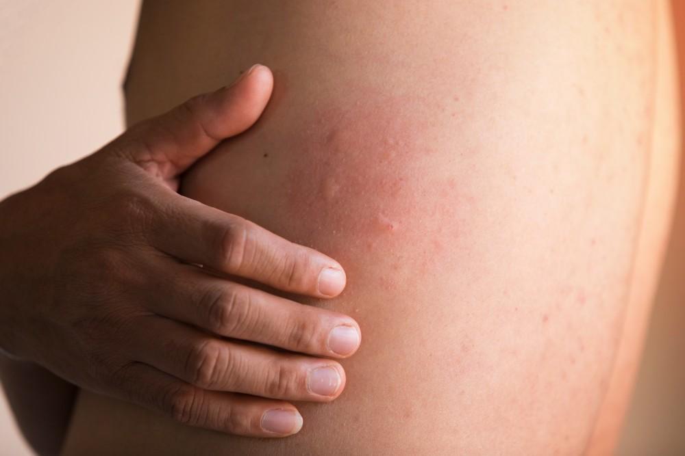 5 Cara Efektif Mengatasi Kulit Gatal dan Iritasi