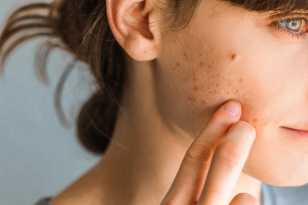 7 Tips Mengatasi Jerawat Akibat Stres