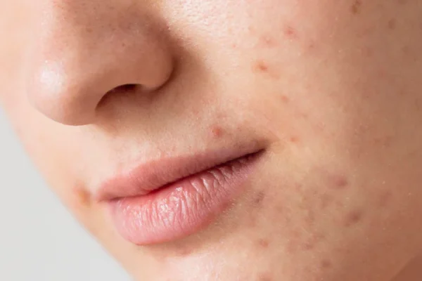 7 Tips Perawatan Jerawat untuk Kulit Sensitif