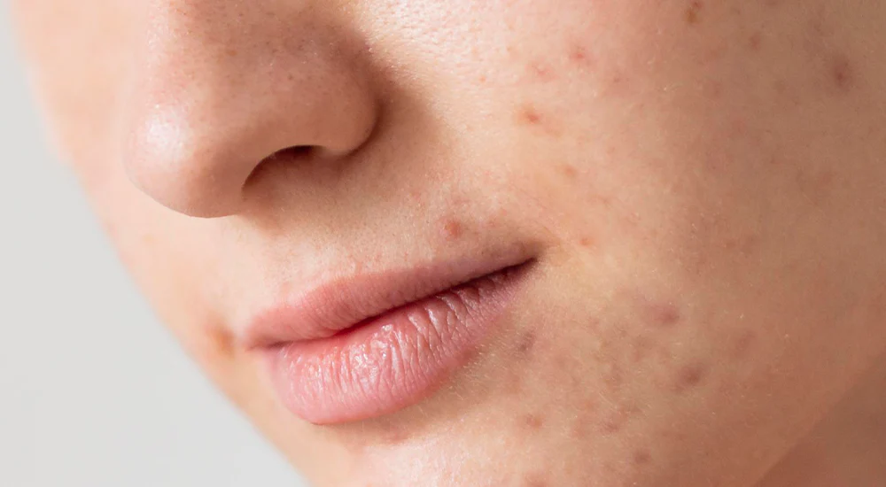 7 Tips Perawatan Jerawat untuk Kulit Sensitif