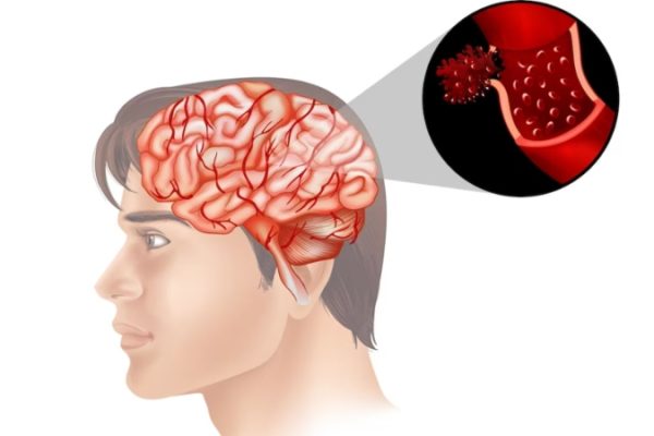 7 Hal yang Harus Dilakukan Segera Setelah Serangan Stroke Lumpuh