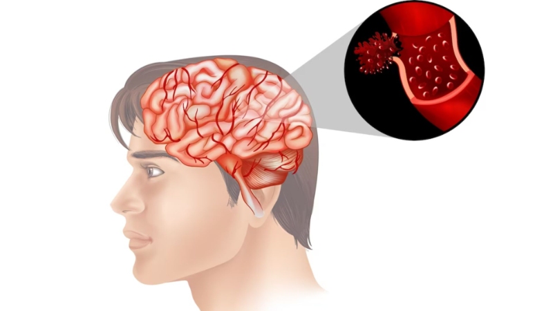 7 Hal yang Harus Dilakukan Segera Setelah Serangan Stroke Lumpuh