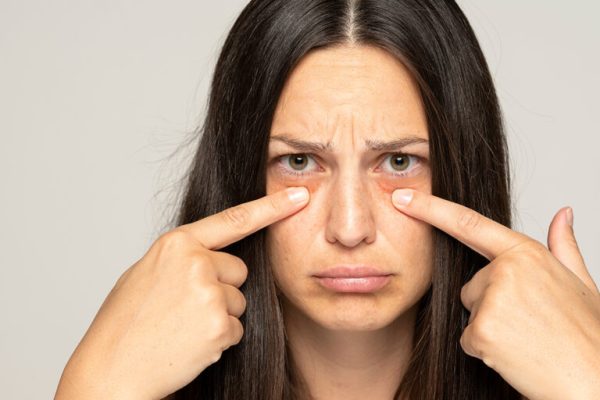 7 Trik Mengurangi Mata Bengkak Akibat Kurang Tidur