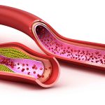 7 Tips Mengontrol Kolesterol Demi Pembuluh Darah Sehat