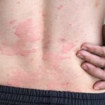 10 Cara Mengatasi Alergi Urtikaria Secara Alami