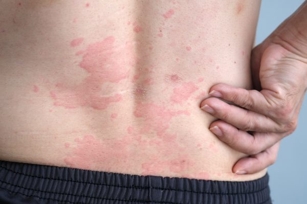 10 Cara Mengatasi Alergi Urtikaria Secara Alami 10 Cara Mengatasi Alergi Urtikaria Secara Alami