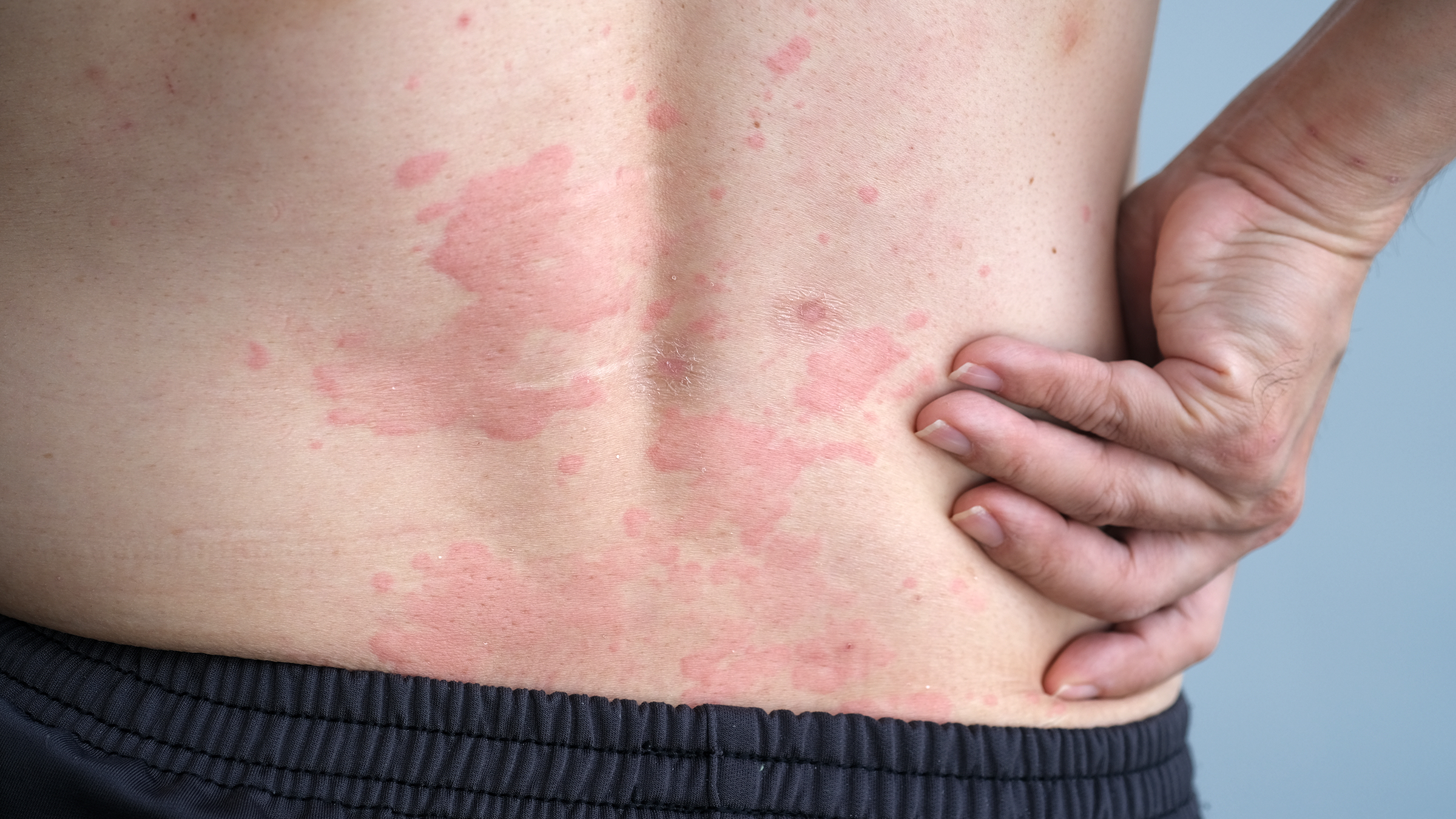 10 Cara Mengatasi Alergi Urtikaria Secara Alami