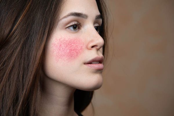 7 Cara Mengatasi Kulit Sensitif agar Tidak Mudah Iritasi